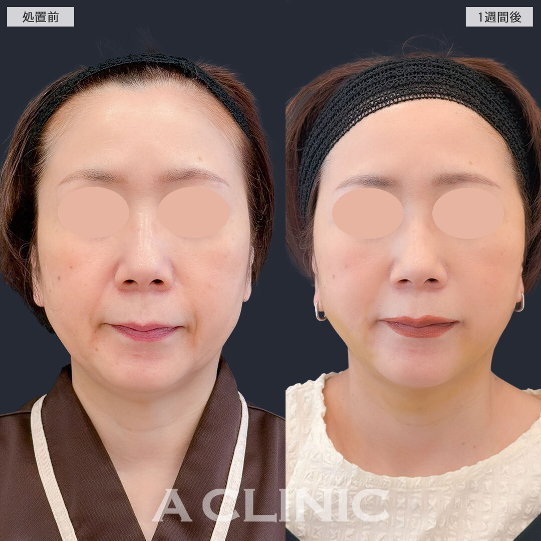 A式美肌たるみ切開と1day小顔脂肪吸引で老け見えの原因であるたるみを改善できます！こちら処置前と1週間後の症例です(50代女性)