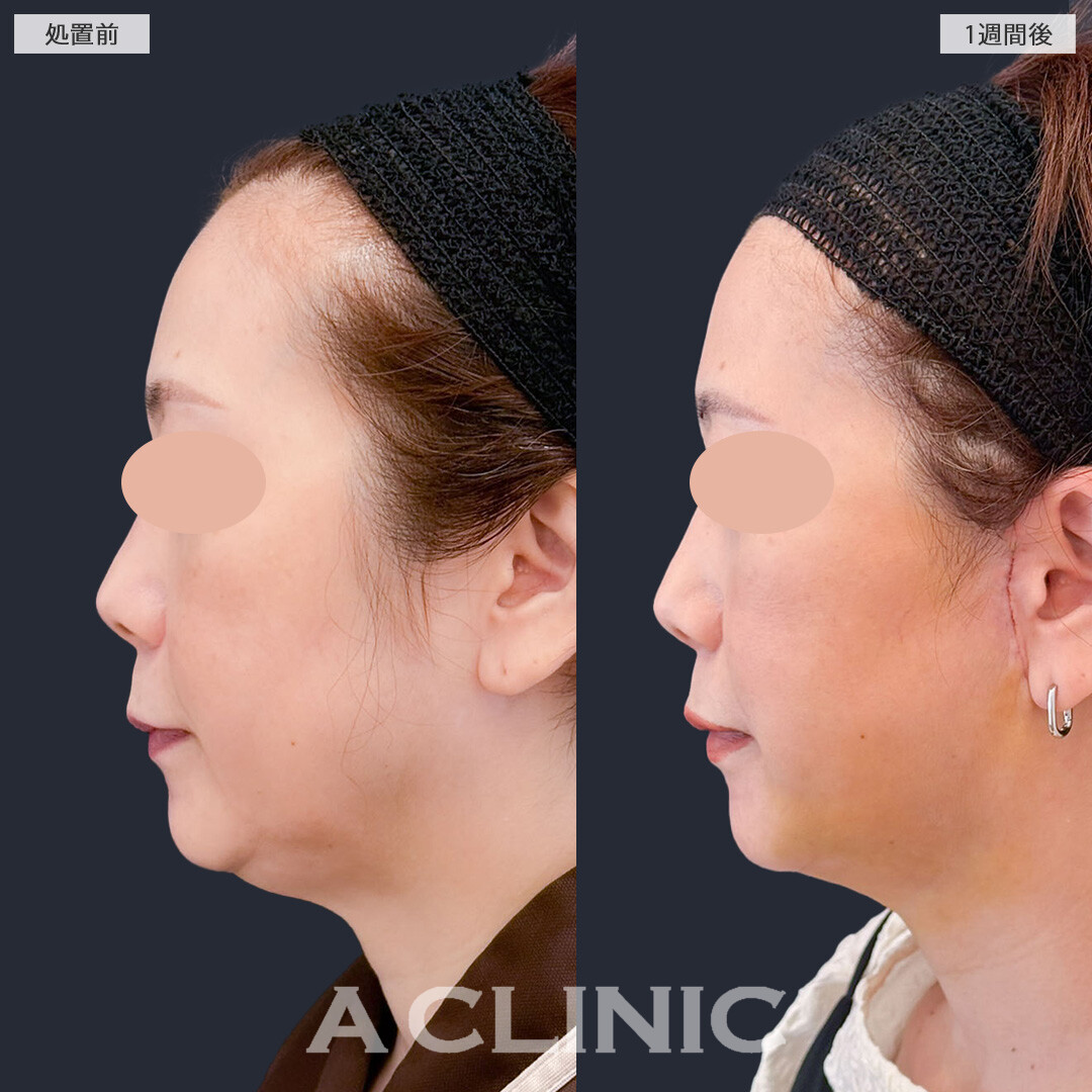 A式美肌たるみ切開と1day小顔脂肪吸引で老け見えの原因であるたるみを改善できます！こちら処置前と1週間後の症例です(50代女性)