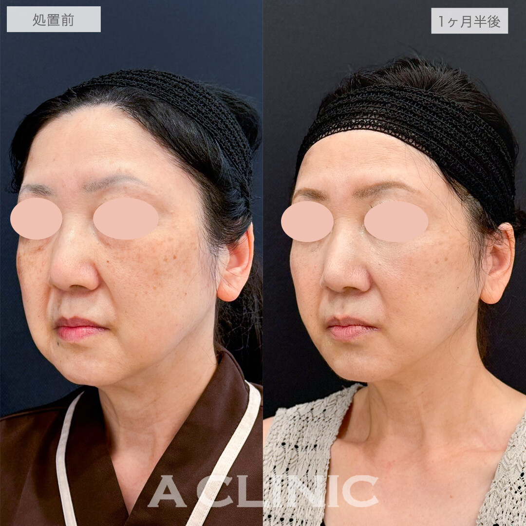 フェイスリフトで若返りながら小顔になれる！処置前と1ヶ月半後の症例です(50代女性)