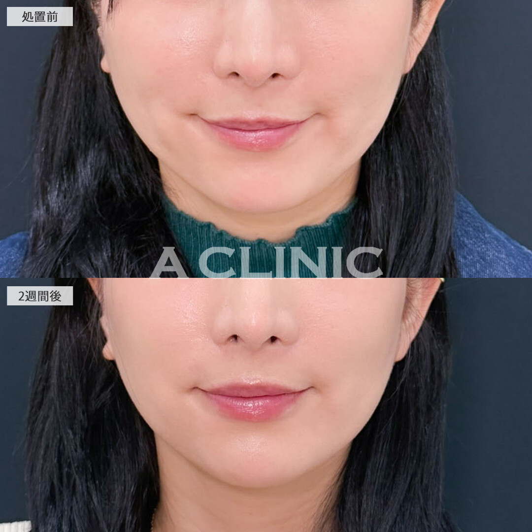 A式美肌たるみ切開でリフトアップして圧倒的若返り効果！こちら処置前と2週間後の症例です(30代女性)