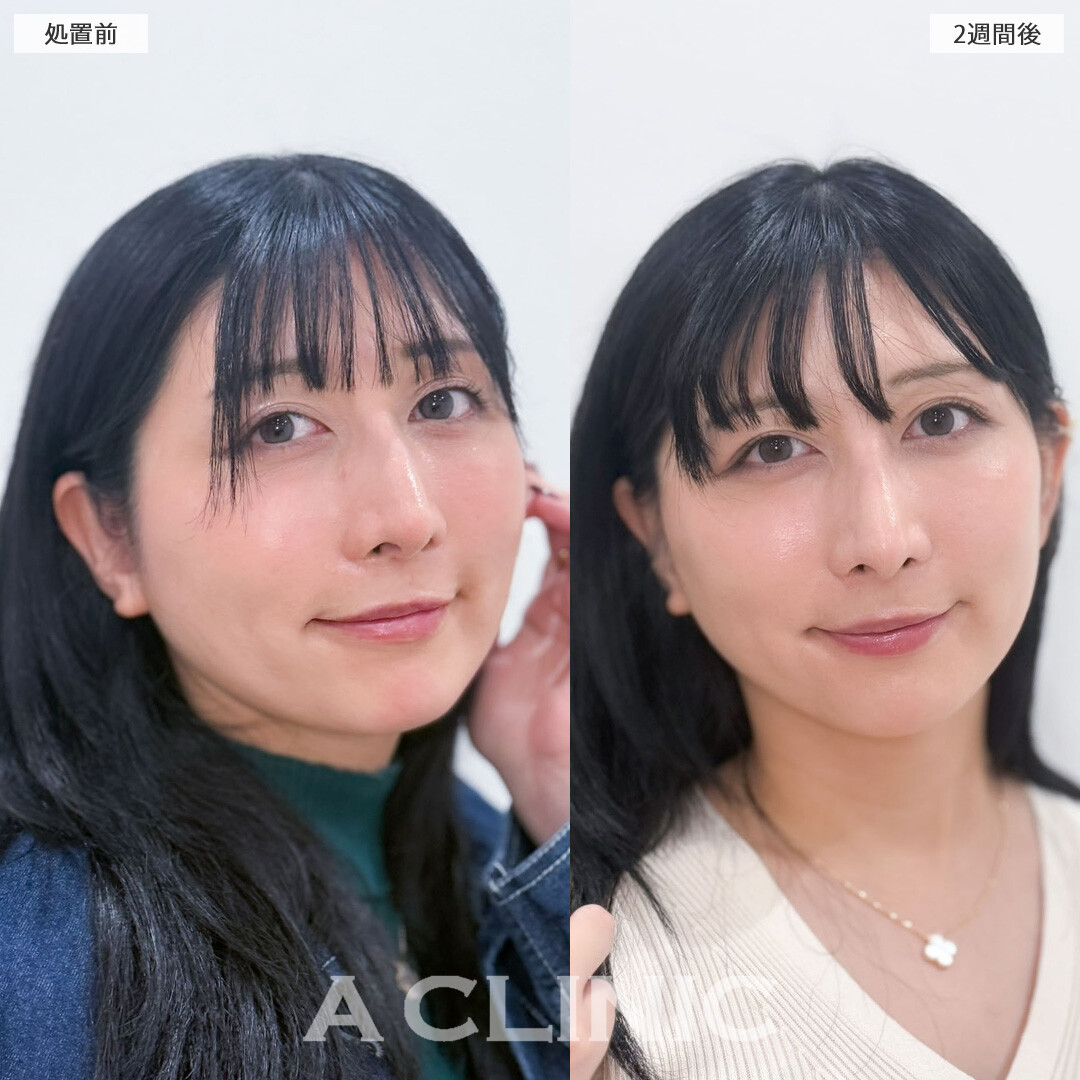 A式美肌たるみ切開でリフトアップして圧倒的若返り効果！こちら処置前と2週間後の症例です(30代女性)