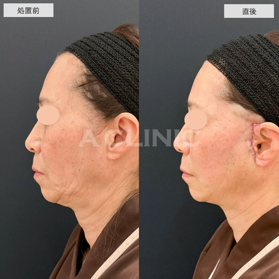 【直後の傷跡あり】A式美肌たるみ切開で顔のたるみを根本的に解決します!こちら処置前と直後の症例です(50代女性)