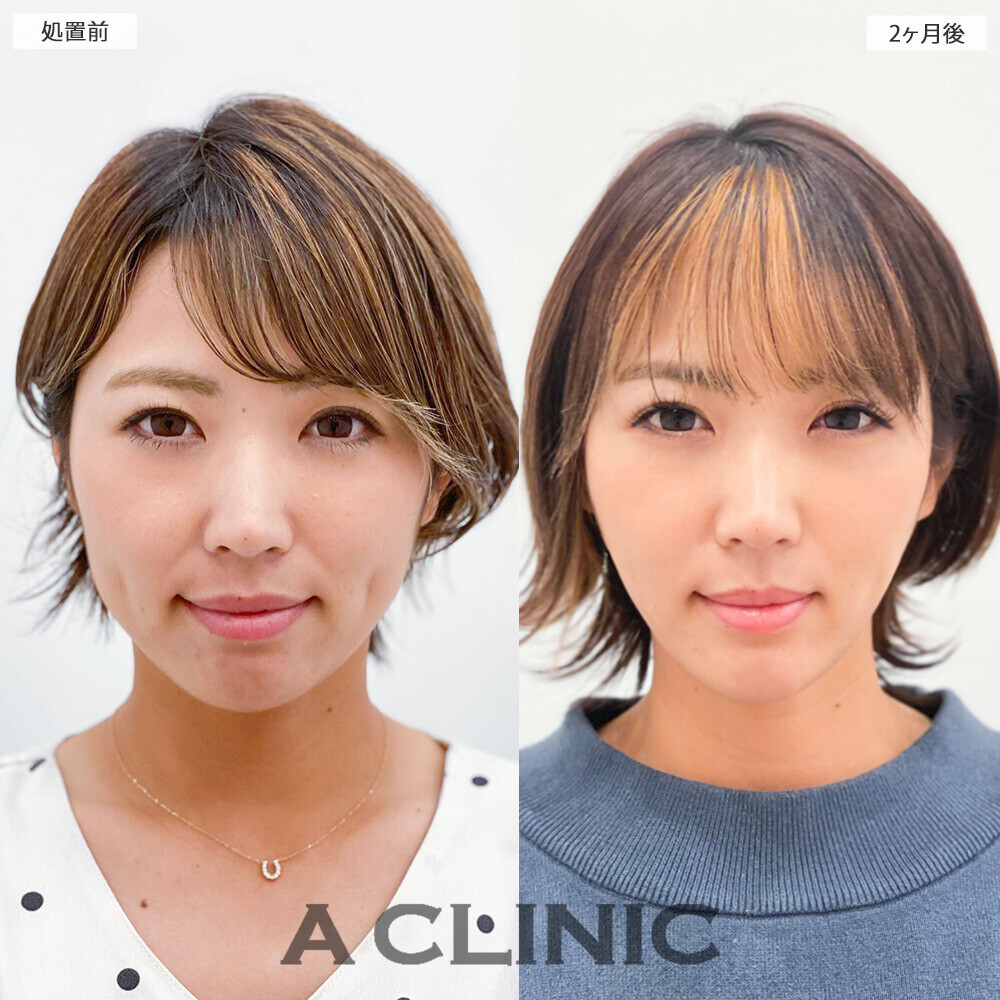 1day小顔脂肪吸引で重たく見えていた顔がスッキリ改善！こちら処置前から2ヶ月後の症例です(30代女性)
