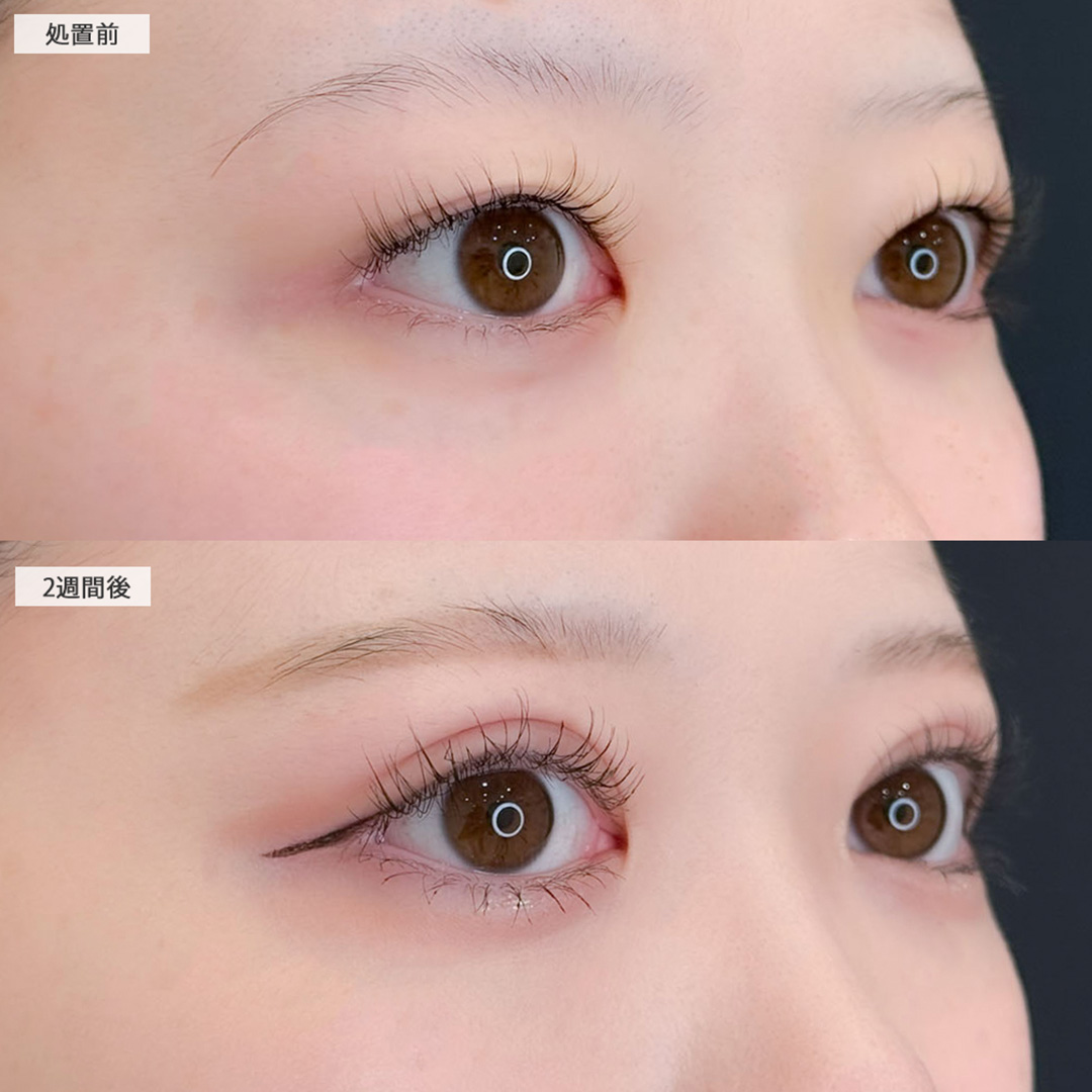 二重術埋没法でアイテープいらずのぱっちりキュートな二重に！こちら処置前と2週間後の症例です(20代女性)