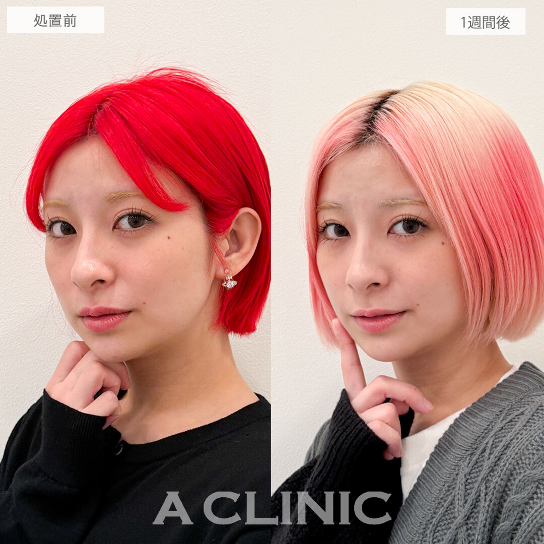 パーフェクトアイズで目の左右差改善！処置前と1週間後の症例です(20代女性)