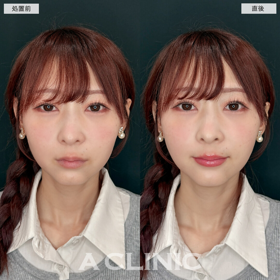 スマイルリップでボリュームのあるぷっくり唇に！処置前と直後の症例です(30代女性)