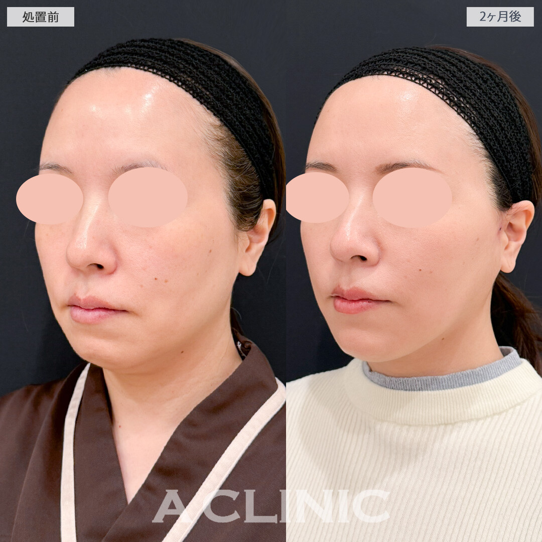 1day小顔脂肪吸引とA式美肌たるみ切開でたるみも脂肪もスッキリ解消！処置前と2ヶ月後の症例です(40代女性)