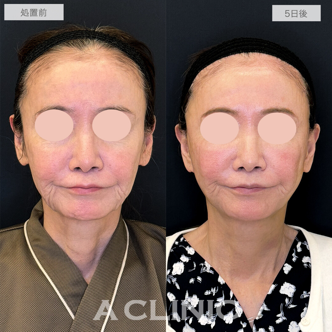 A式美肌たるみ切開で劇的に若返り！処置前と5日後の症例です(60代女性)