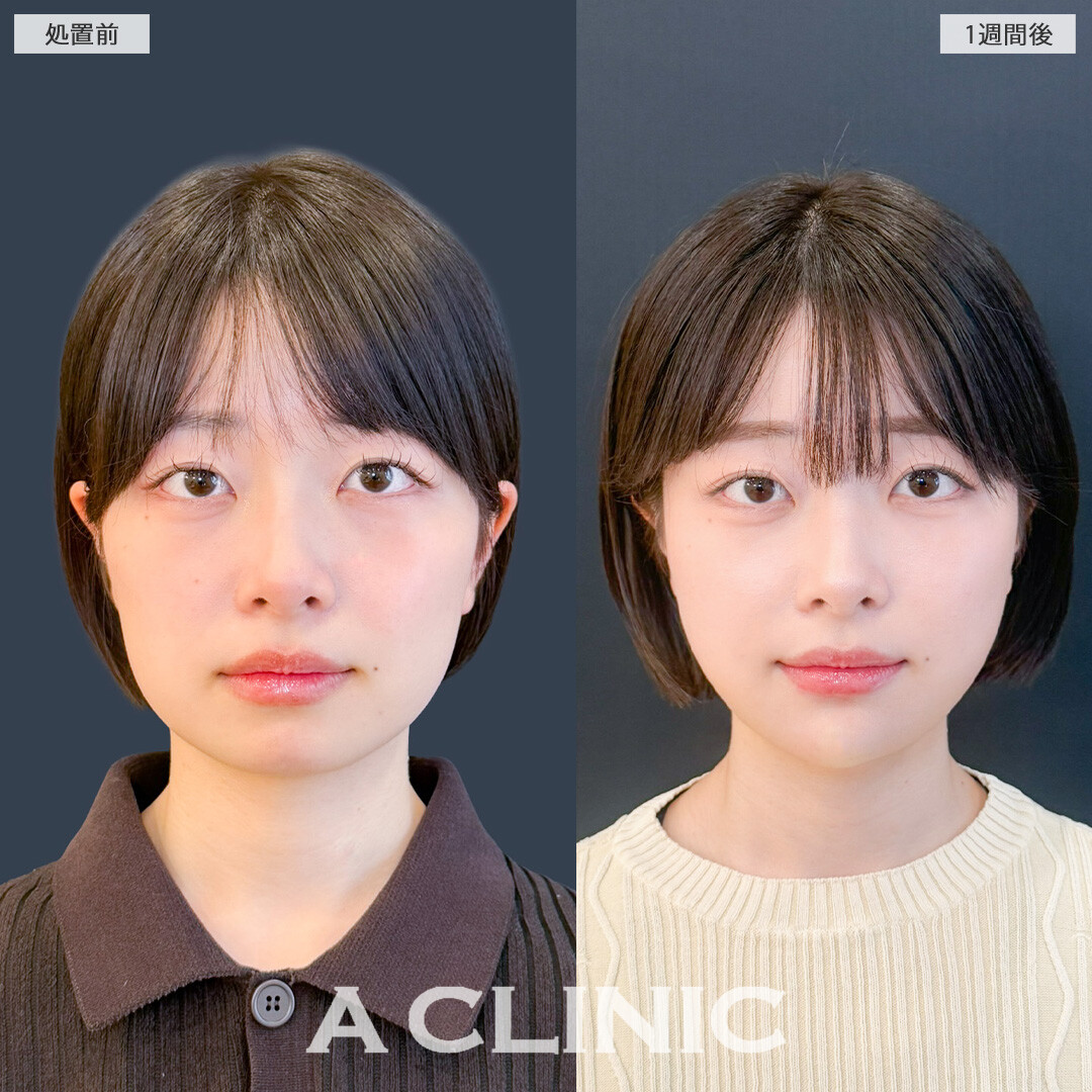 1day小顔脂肪吸引なら1週間後でもここまで腫れが少なくダウンタイム最小限！こちら処置前と1週間後の症例です(20代女性)