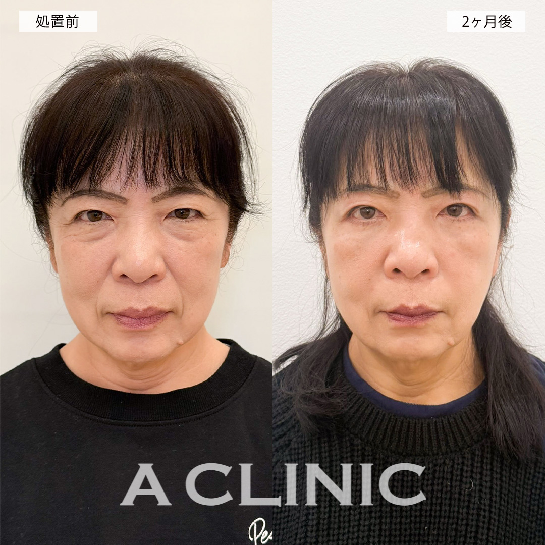 複合施術でお顔の印象が柔らかくなり自分に自信が持てるようになりました！処置前と2ヶ月後の症例です(60代女性)