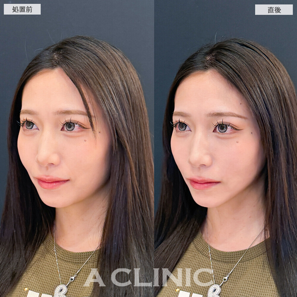 Aスレッドで顔の余白感改善！こちら処置前と直後の症例です(20代女性)