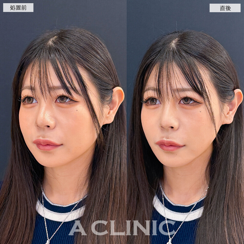 Aスレッドで下膨れ顔が一気にリフトアップ！こちら処置前と直後の症例です(20代女性)
