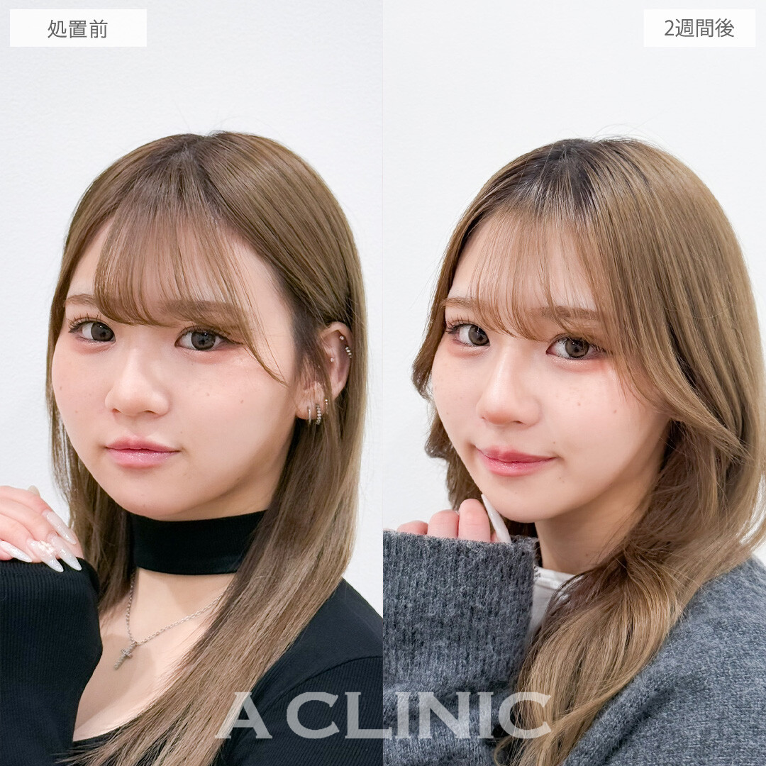 ヒアルロン酸カスタマイズメニューで鼻としわのお悩み同時に解決できました！こちら処置前と2週間後の症例です(20代女性)