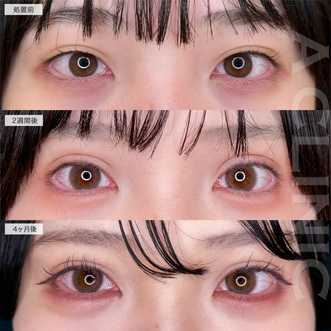 二重術埋没法ですっぴんでも盛れる二重に！こちら処置前から4ヶ月後の症例です(20代女性)