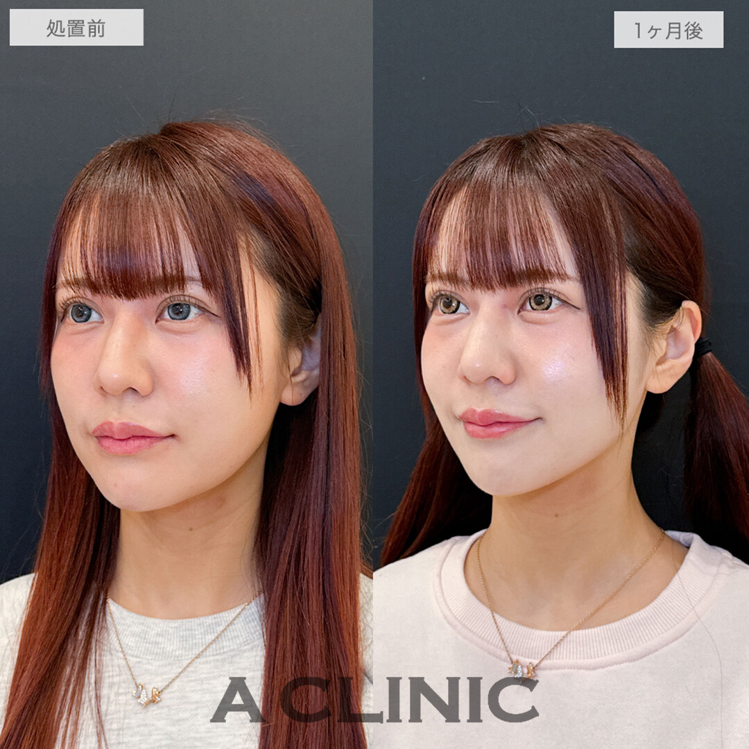 1day小顔脂肪吸引でフェイスラインがくっきりし口横のもたつきもなくなりました！処置前と1ヶ月後の症例です(30代女性)
