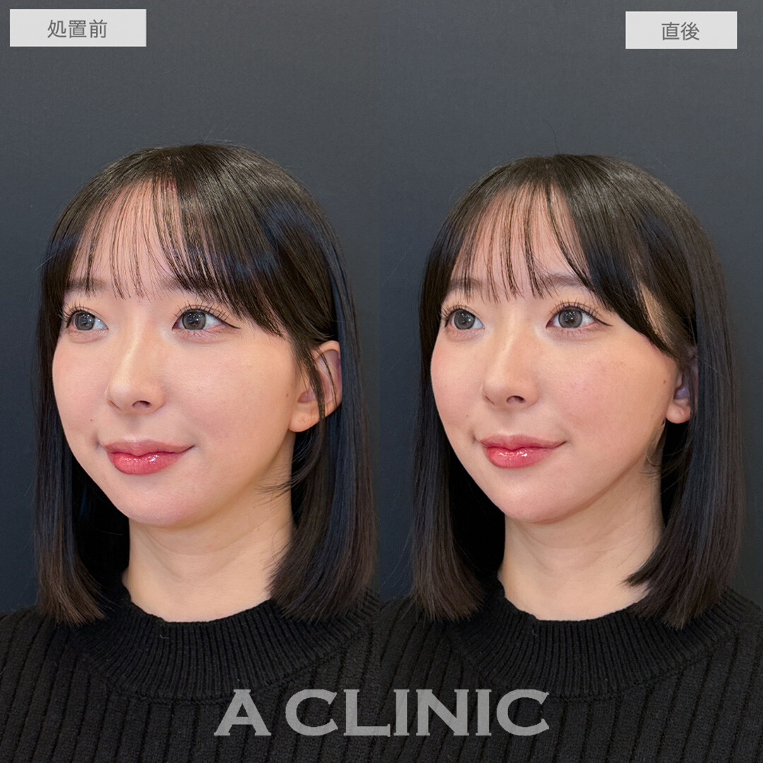 1day小顔脂肪吸引とあごへのヒアルロン酸注入で直後から憧れのVフェイスに！処置前と直後の症例です(20代女性)