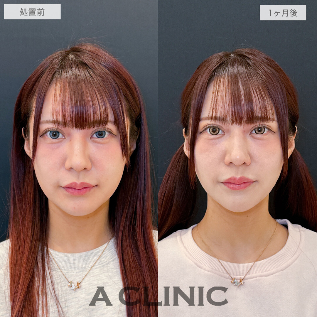 1day小顔脂肪吸引でフェイスラインがくっきりし口横のもたつきもなくなりました！処置前と1ヶ月後の症例です(30代女性)
