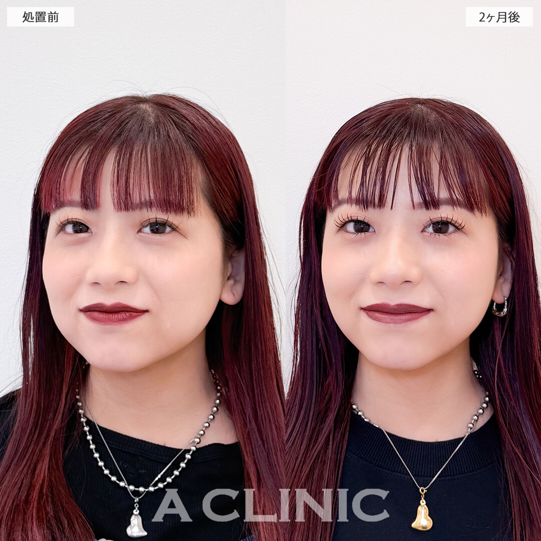 1day小顔脂肪吸引で脂肪のもたつきを減らして垢抜け小顔に！こちら処置前と2ヶ月後の症例です(20代女性)
