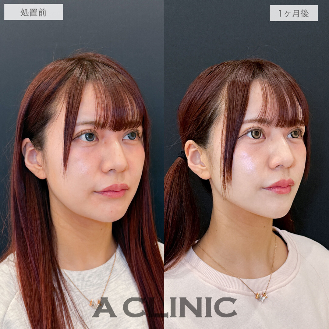 1day小顔脂肪吸引でフェイスラインがくっきりし口横のもたつきもなくなりました！処置前と1ヶ月後の症例です(30代女性)