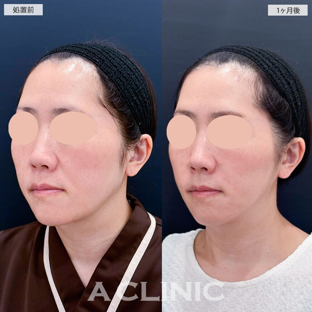 A式美肌たるみ切開でフェイスラインのたるみが改善！こちら処置前から2ヶ月後の症例です(40代女性)