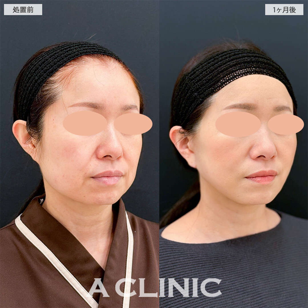 A式美肌たるみ切開で念願の若返りに成功しました！こちら処置前と1ヶ月後の症例です(40代女性)