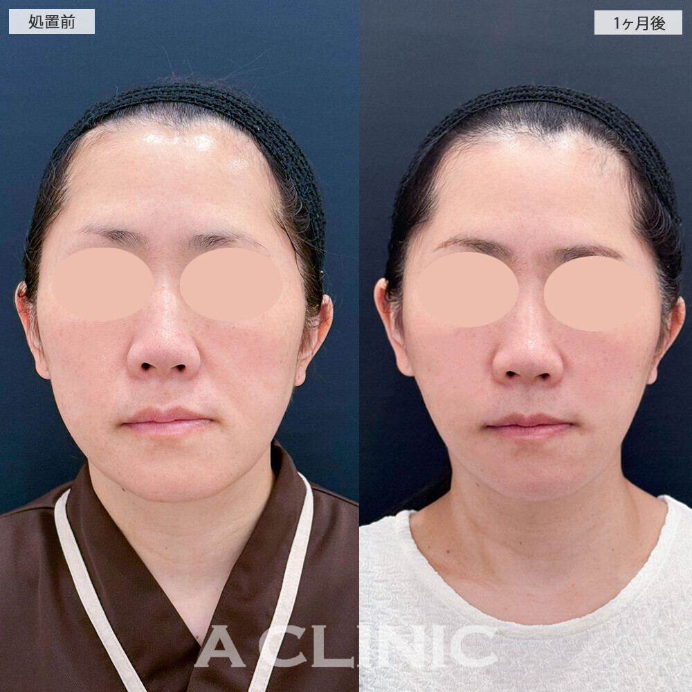 A式美肌たるみ切開でフェイスラインのたるみが改善！こちら処置前から2ヶ月後の症例です(40代女性)