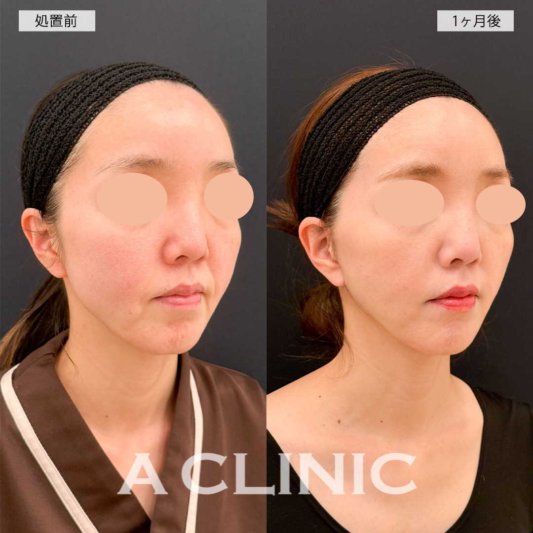 【直後の傷跡あり】A式美肌たるみ切開でフェイスラインのもたつきが改善され若返り！こちら処置前から1ヶ月後の症例です(40代女性)