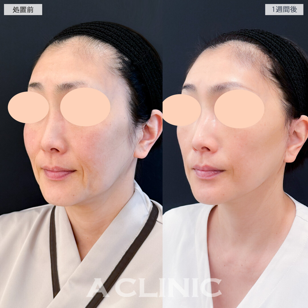 【直後の傷跡あり】A式美肌たるみ切開でたるみ改善と予防どちらも叶う！処置前と1週間後の症例です(50代女性)