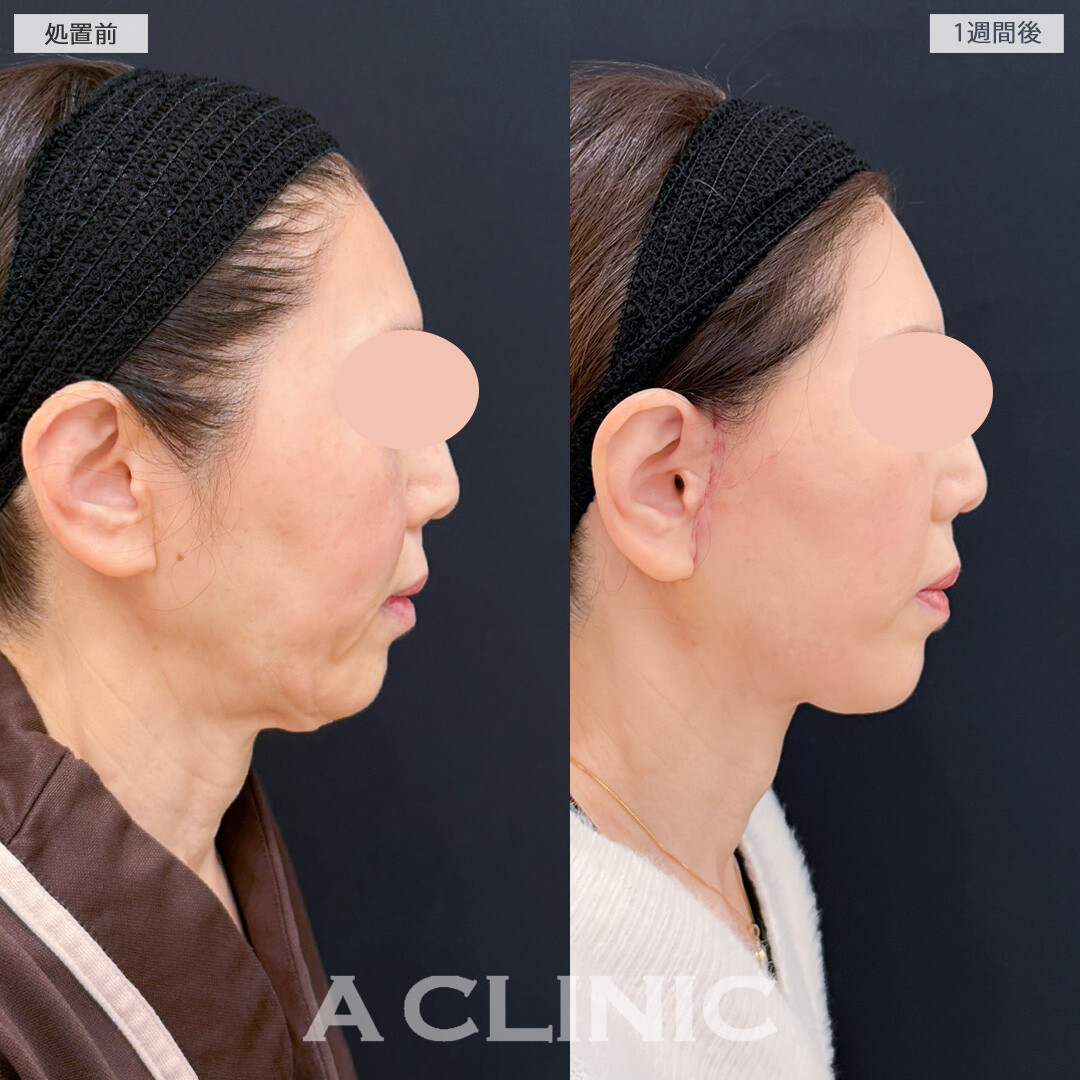 A式美肌たるみ切開でたるみが解消されフェイスラインがスッキリしました！処置前と1週間後の症例です(50代女性)