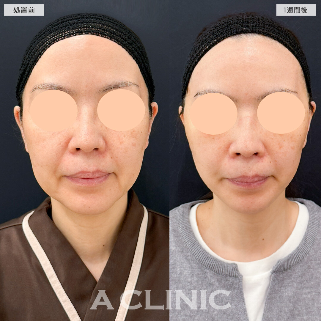 【直後の傷跡あり】A式美肌たるみ切開で年齢の出やすい口横やフェイスラインのもたつきがここまで変わりました！処置前と1週間後の症例です(40代女性)