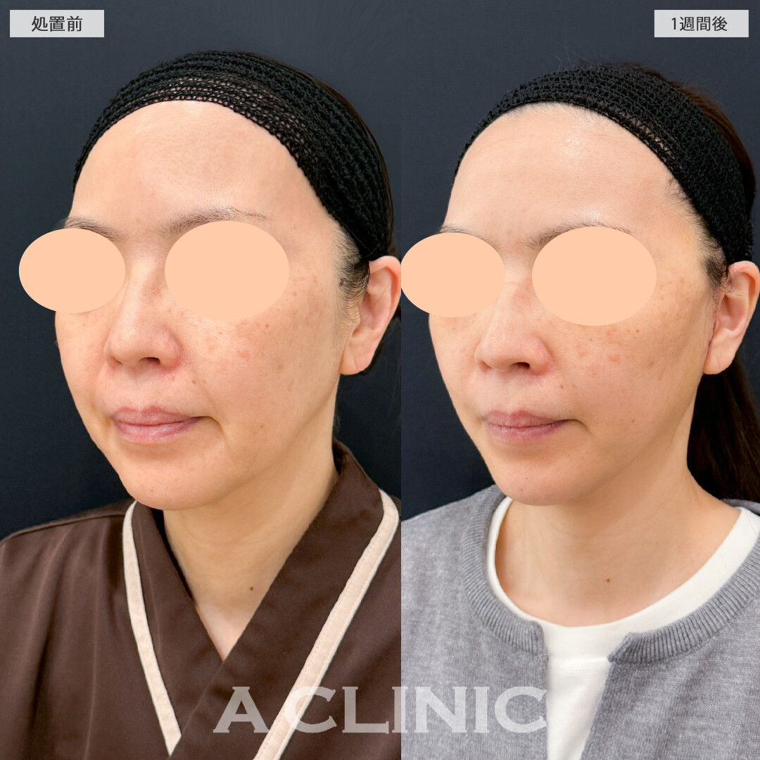 【直後の傷跡あり】A式美肌たるみ切開で年齢の出やすい口横やフェイスラインのもたつきがここまで変わりました！処置前と1週間後の症例です(40代女性)