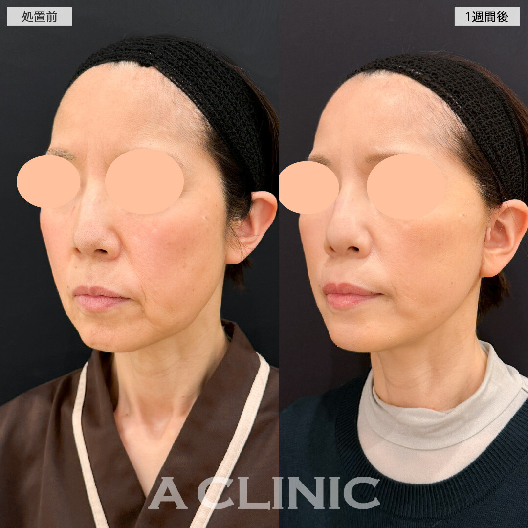 【直後の傷跡あり】A式美肌たるみ切開で口横のたるみが激減！処置前と1週間後の症例です(50代女性)