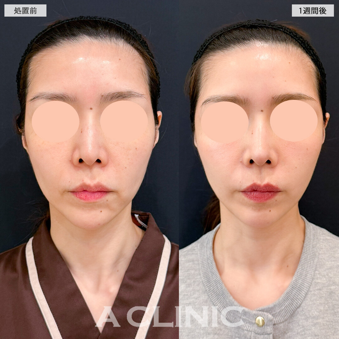 【直後の傷跡あり】A式美肌たるみ切開で年齢の出やすいほうれい線にアプローチ！処置前と1週間後の症例です(40代女性)