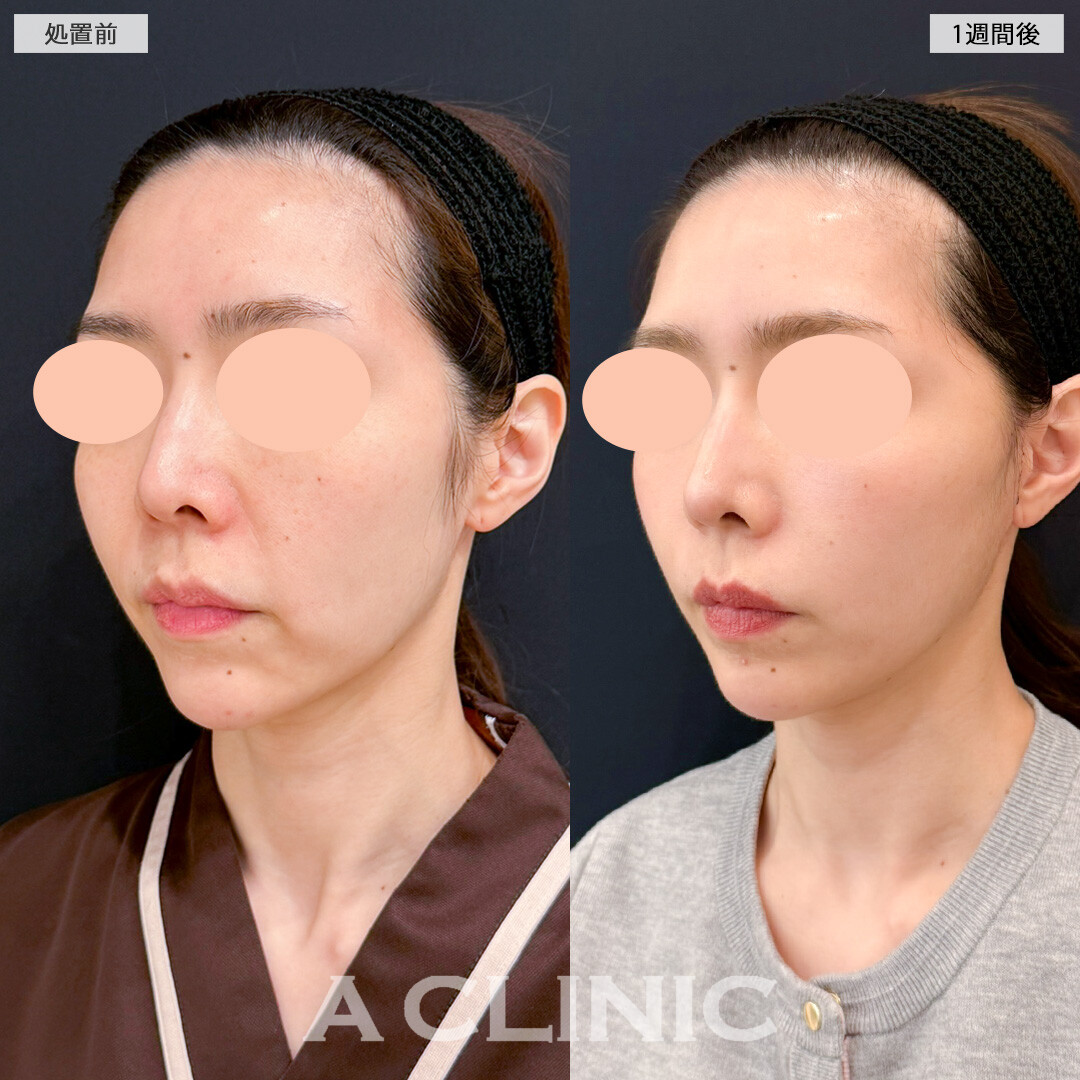 【直後の傷跡あり】A式美肌たるみ切開で年齢の出やすいほうれい線にアプローチ！処置前と1週間後の症例です(40代女性)