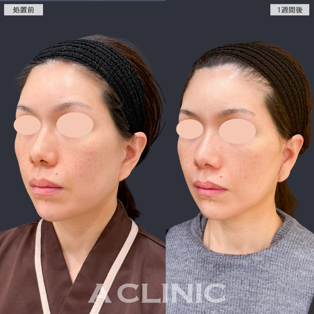 【直後の傷跡あり】A式美肌たるみ切開で若々しいシャープなフェイスラインに！こちら処置前と1週間後の症例です(40代女性)