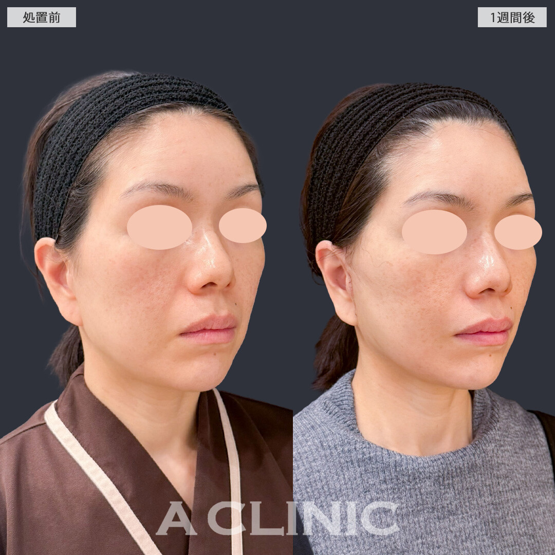 【直後の傷跡あり】A式美肌たるみ切開で若々しいシャープなフェイスラインに！こちら処置前と1週間後の症例です(40代女性)