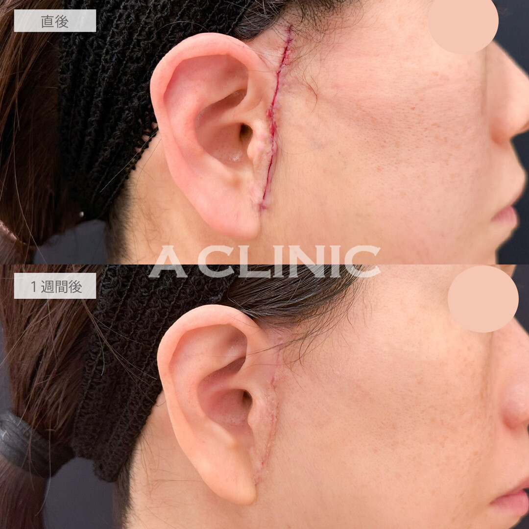 【直後の傷跡あり】A式美肌たるみ切開で若々しいシャープなフェイスラインに！こちら処置前と1週間後の症例です(40代女性)