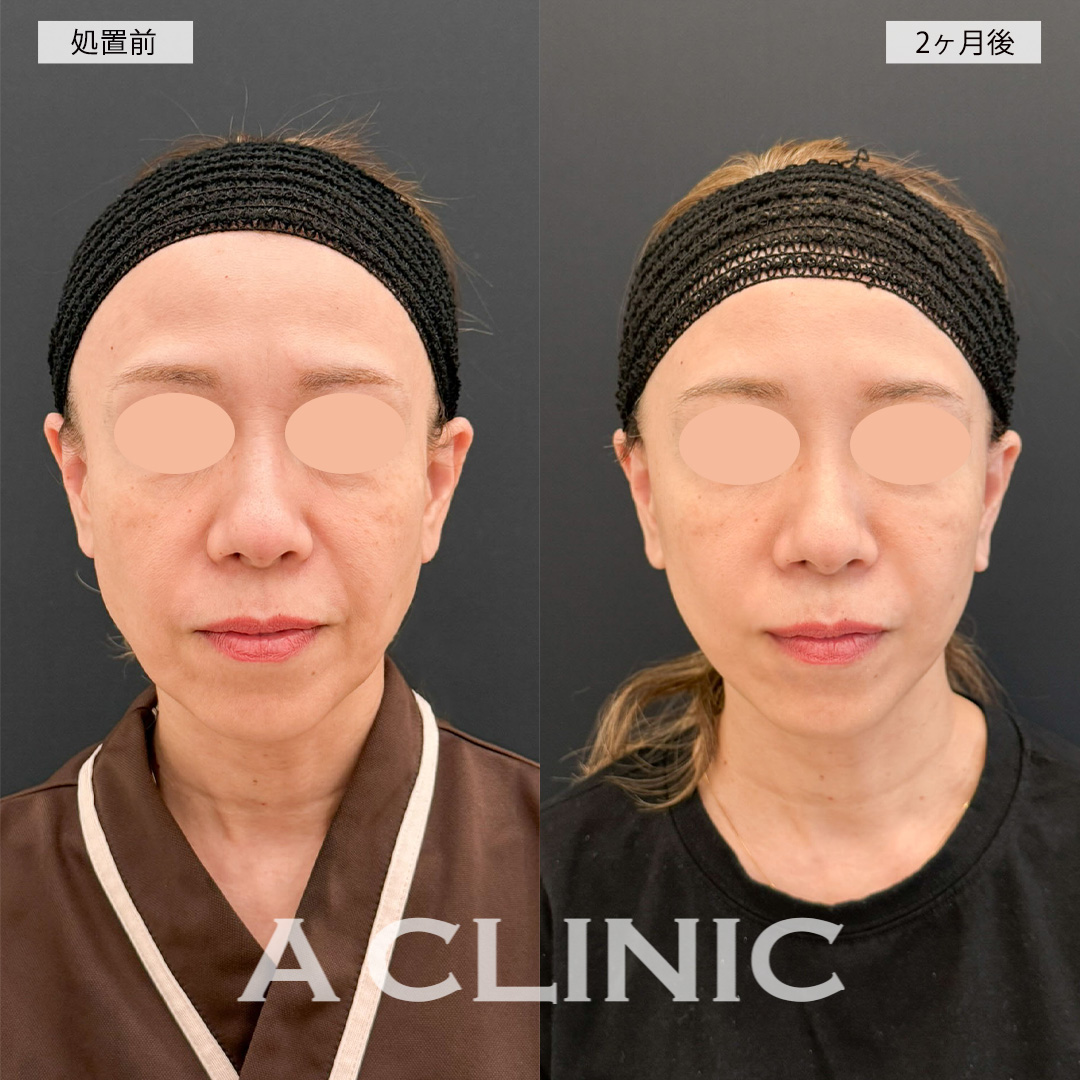 【直後の傷跡あり】A式美肌たるみ切開で口元のシワが薄くなり若返った印象に！こちら処置前と2ヶ月後の症例です(50代女性)