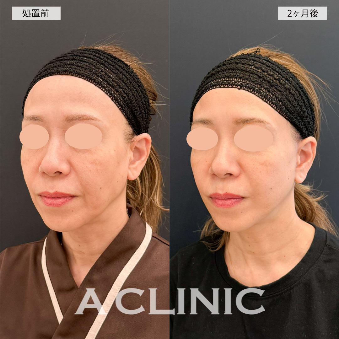 【直後の傷跡あり】A式美肌たるみ切開で口元のシワが薄くなり若返った印象に！こちら処置前と2ヶ月後の症例です(50代女性)
