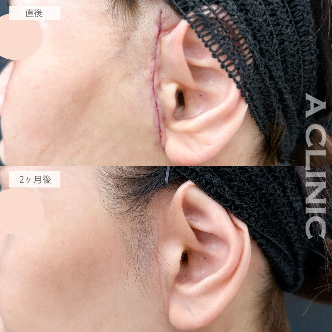 【直後の傷跡あり】A式美肌たるみ切開は1回の施術で高い若返り効果を実感できます！こちら処置前と2ヶ月後の症例です(50代女性)