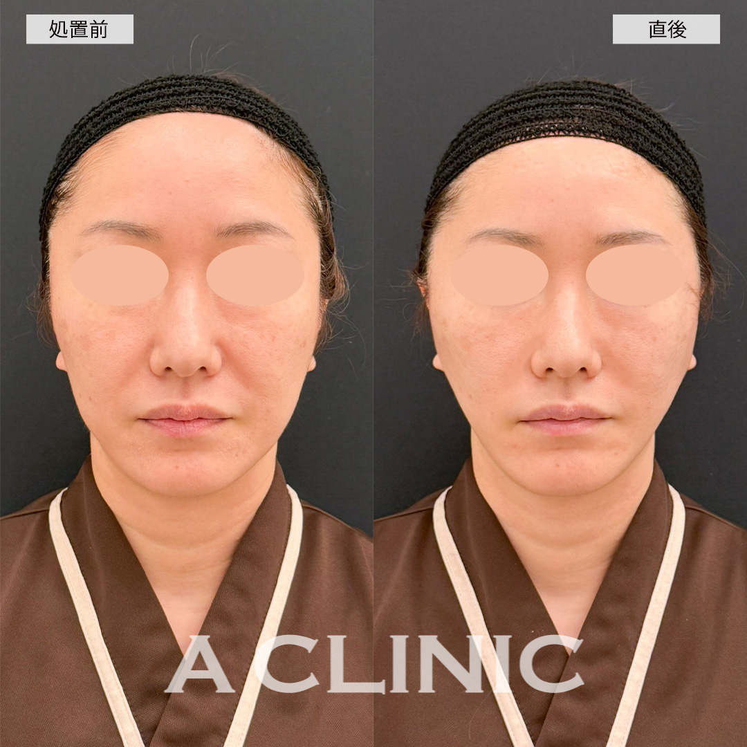 【直後の傷跡あり】A式美肌たるみ切開で直後からお悩みだったシワが改善されました！こちら処置前と直後の症例です(40代女性)