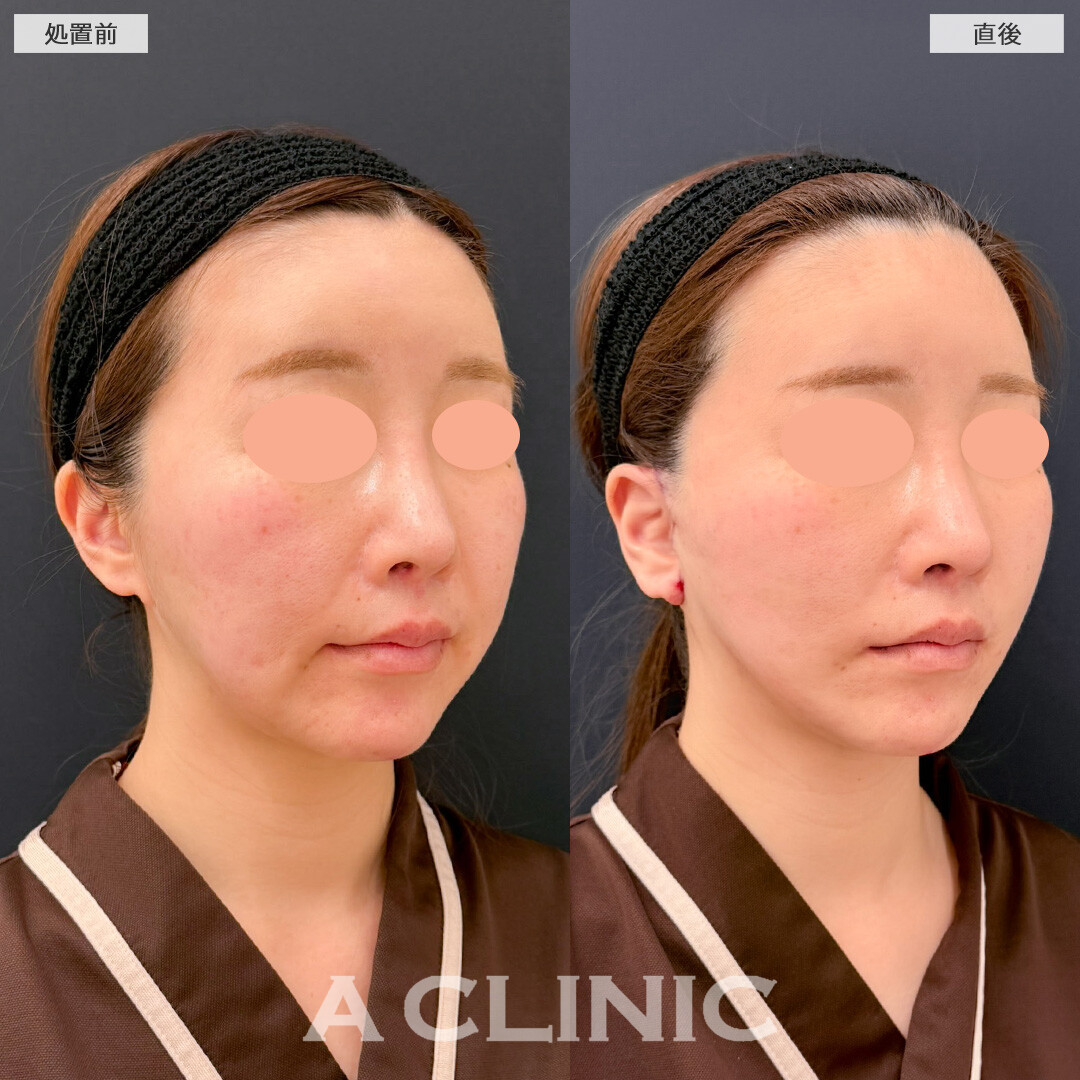 A式美肌たるみ切開でたるんだ皮膚をしっかり引き上げ圧倒的な若返り効果を実感！こちら処置前と直後の症例です(30代女性)
