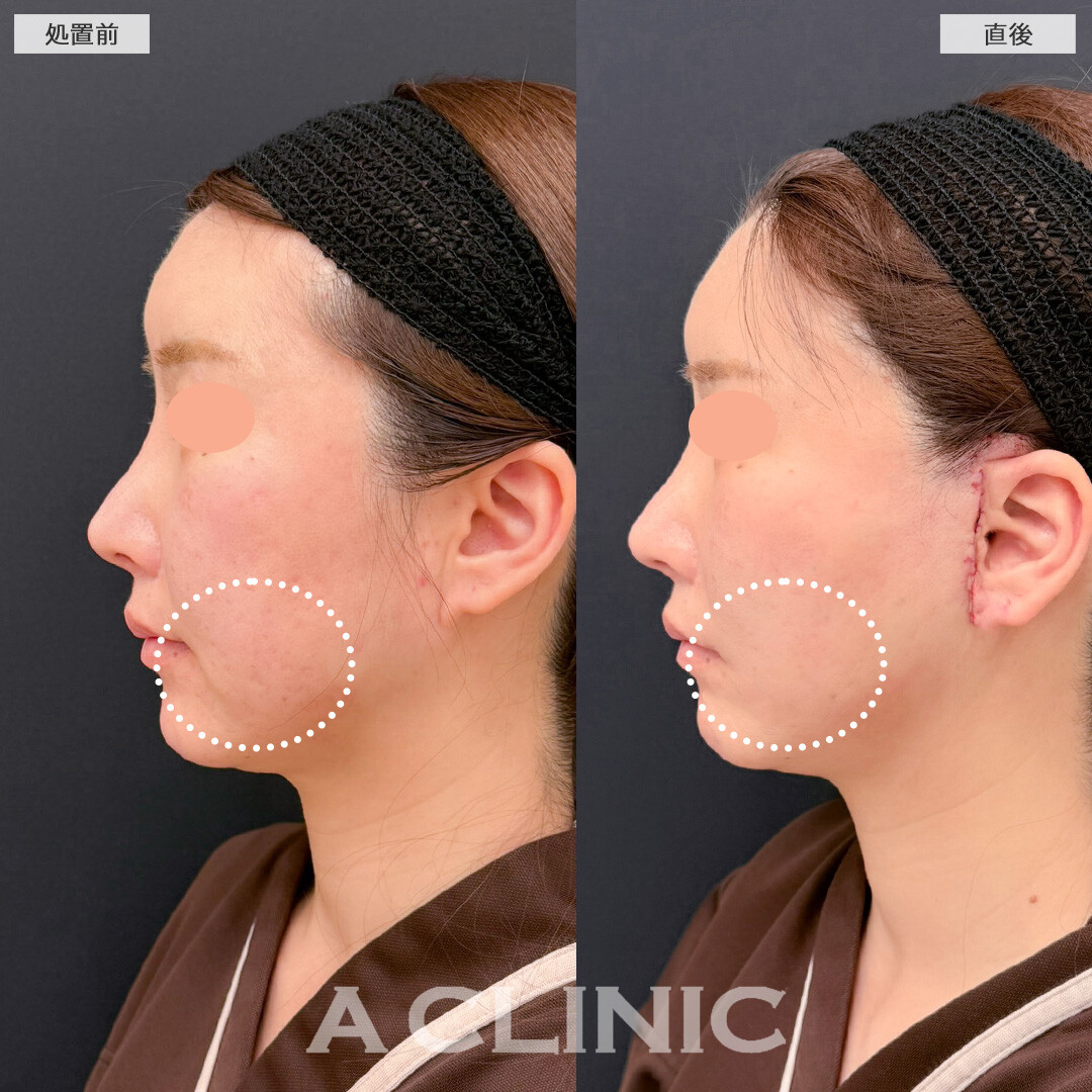 A式美肌たるみ切開でたるんだ皮膚をしっかり引き上げ圧倒的な若返り効果を実感！こちら処置前と直後の症例です(30代女性)
