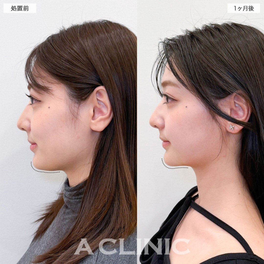1day小顔脂肪吸引と小顔エラボトックスで輪郭のお悩みへ徹底的にアプローチ！こちら処置前と1ヶ月後の症例です(20代女性)