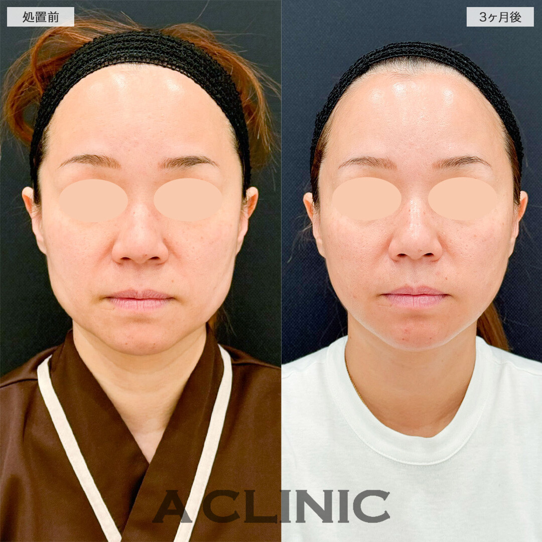 1day小顔脂肪吸引で口元のもたつきが解消し若返りに成功しました！こちら処置前と3ヶ月後の症例です(40代女性)