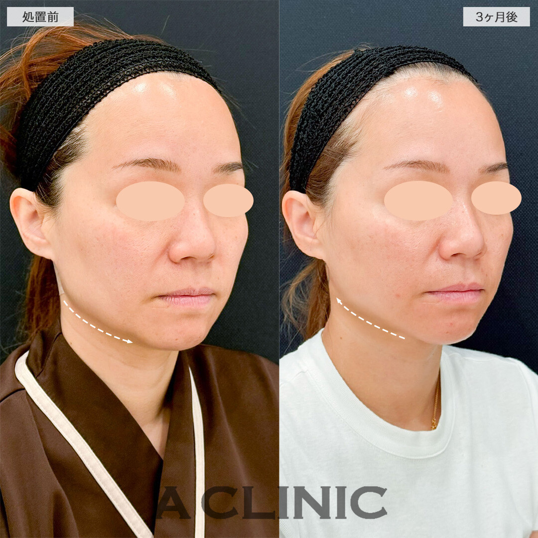 1day小顔脂肪吸引で口元のもたつきが解消し若返りに成功しました！こちら処置前と3ヶ月後の症例です(40代女性)