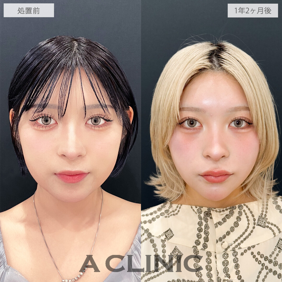 1day小顔脂肪吸引は時間が経ってもシャープな輪郭をキープできます！こちら処置前と1年2ヶ月後の症例です(20代女性)