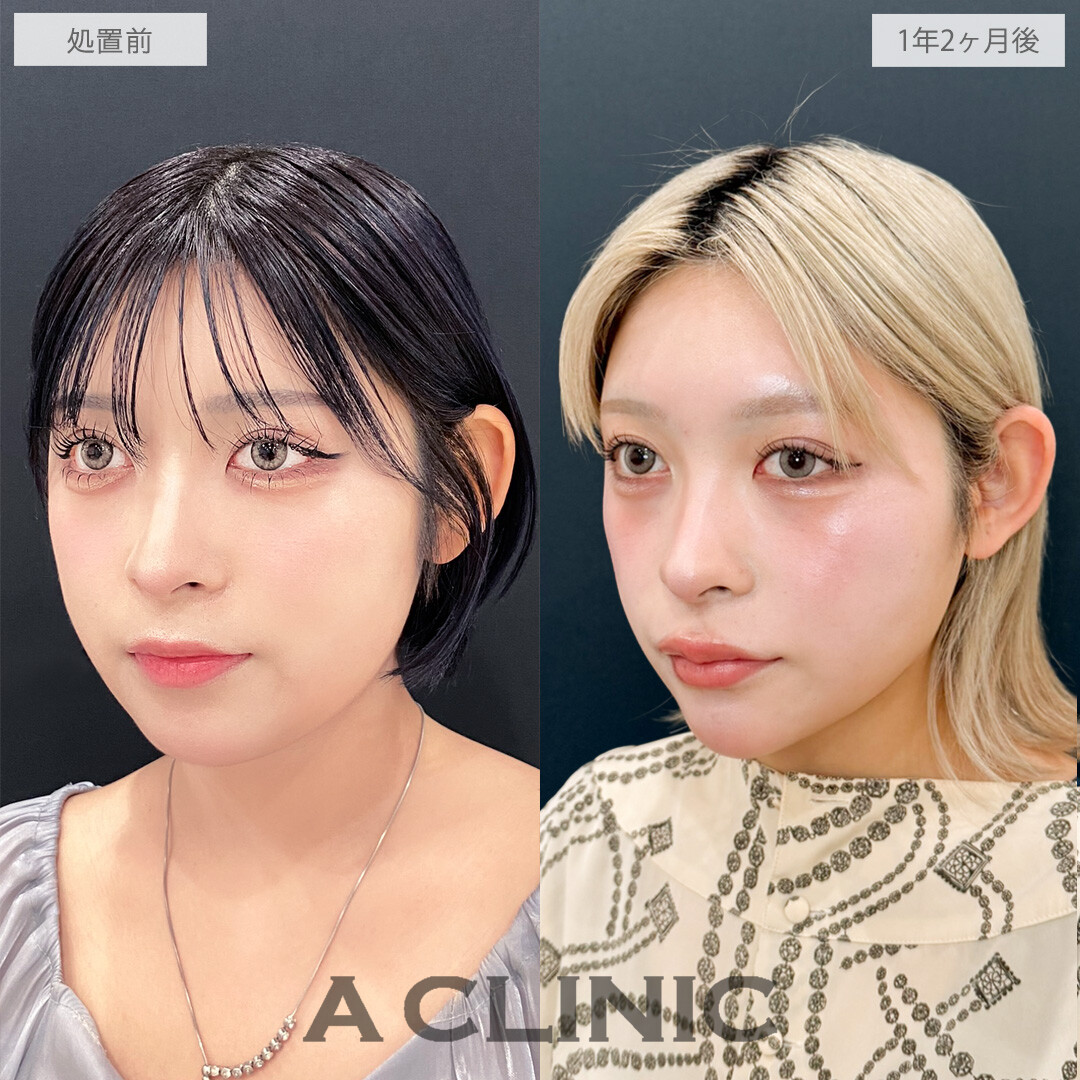 1day小顔脂肪吸引は時間が経ってもシャープな輪郭をキープできます！こちら処置前と1年2ヶ月後の症例です(20代女性)