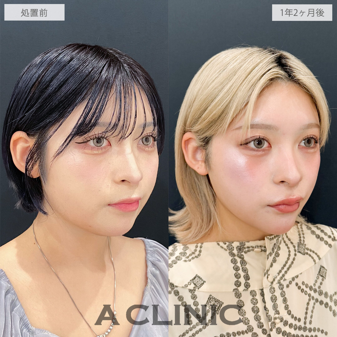 1day小顔脂肪吸引は時間が経ってもシャープな輪郭をキープできます！こちら処置前と1年2ヶ月後の症例です(20代女性)