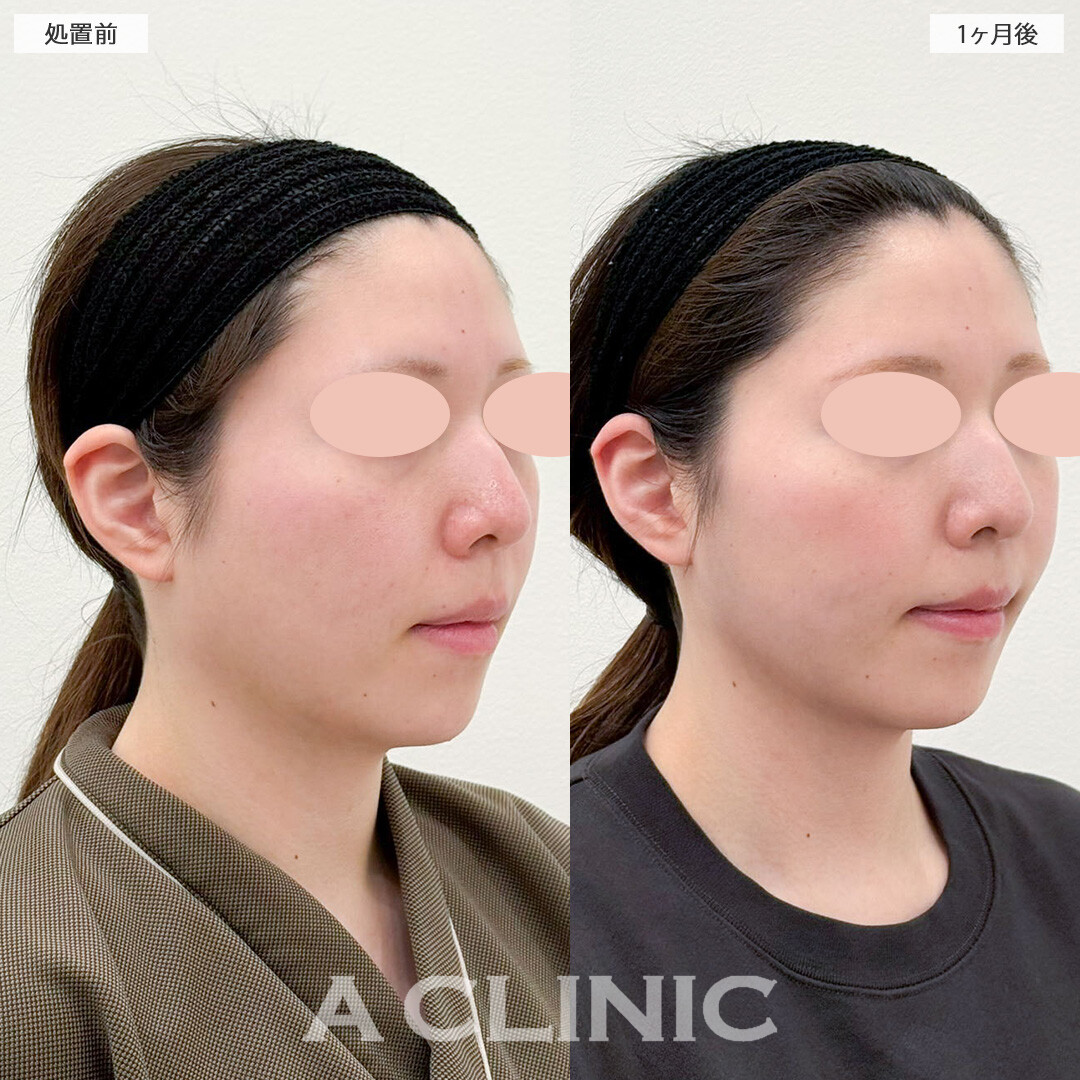 1day小顔脂肪吸引でフェイスラインがくっきり出現しました！こちら処置前と１ヶ月後の症例です(20代女性)